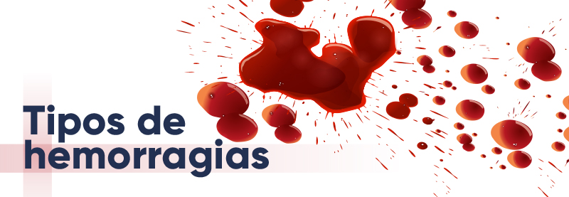 Tipos de hemorragias